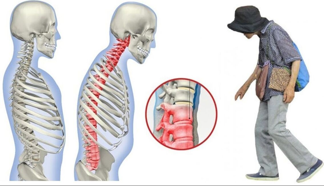 bolest zad způsobená ankylozující spondylitidou