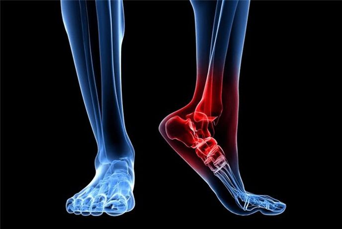 artróza nohy