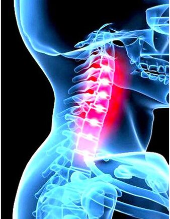 Klinický obraz osteochondrosy